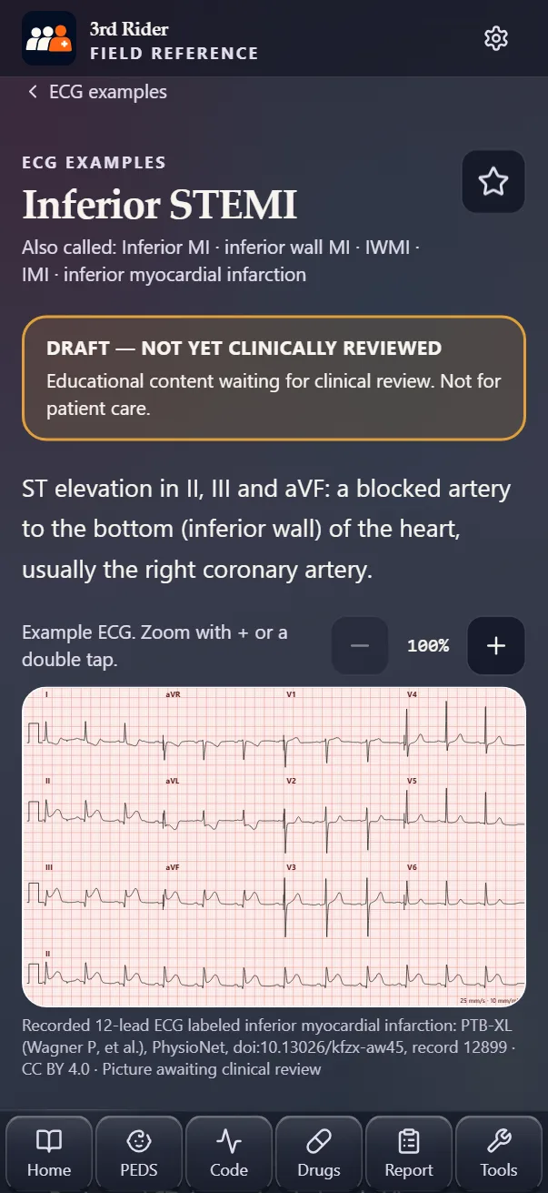 Inferior STEMI page with a recorded 12-lead ECG.